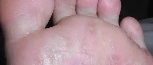 脚底长了像水泡一样的东西很痒是什么原因（脚底长了像水泡一样的东西很痒是什么原因）